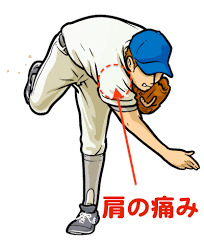 「肩の痛み 野球」の画像検索結果